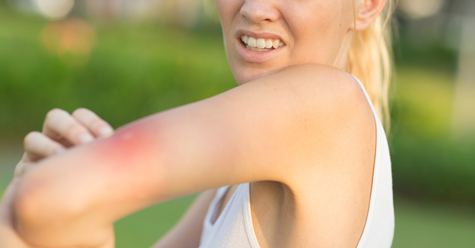 Vemos uma picada de inseto no verão no braço de uma mulher.
